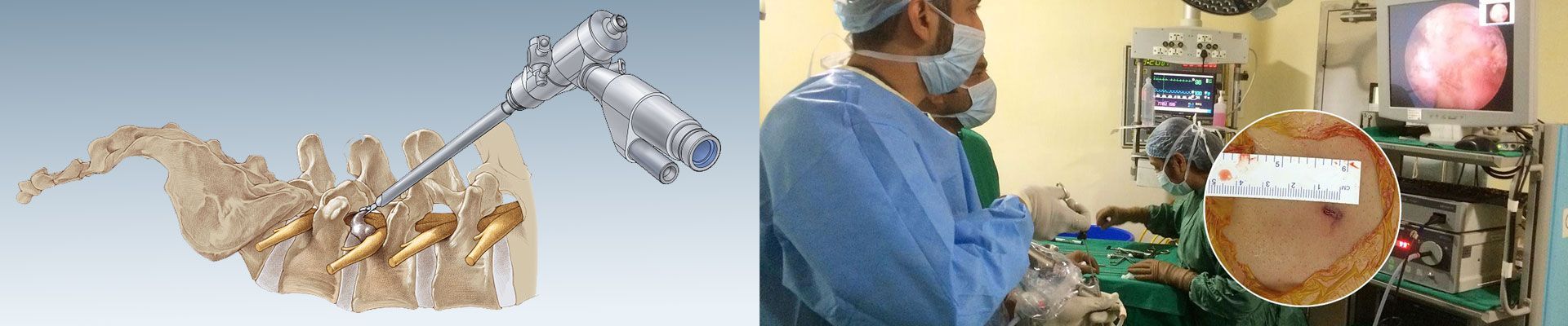 Endoscopic Spine Surgery in mumbai