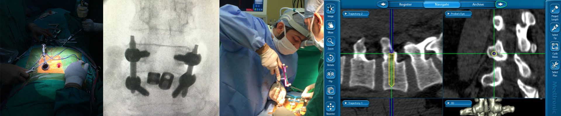 Minimally Invasive and Navigation Guided Gpine Surgery