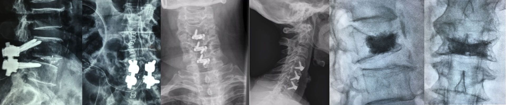 Spine surgery in mumbai