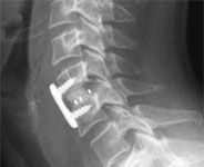 Anterior Cervical Discectomy and Fusion