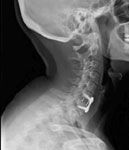 Ankylosing Spondylosis