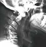 Cervical TB and Corpectomy