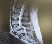 Spondylolisthesis