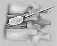 Vertebroplasty
